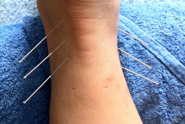acupuncture