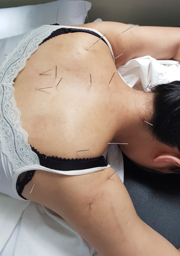 akuunktur_hoch Akupunktur